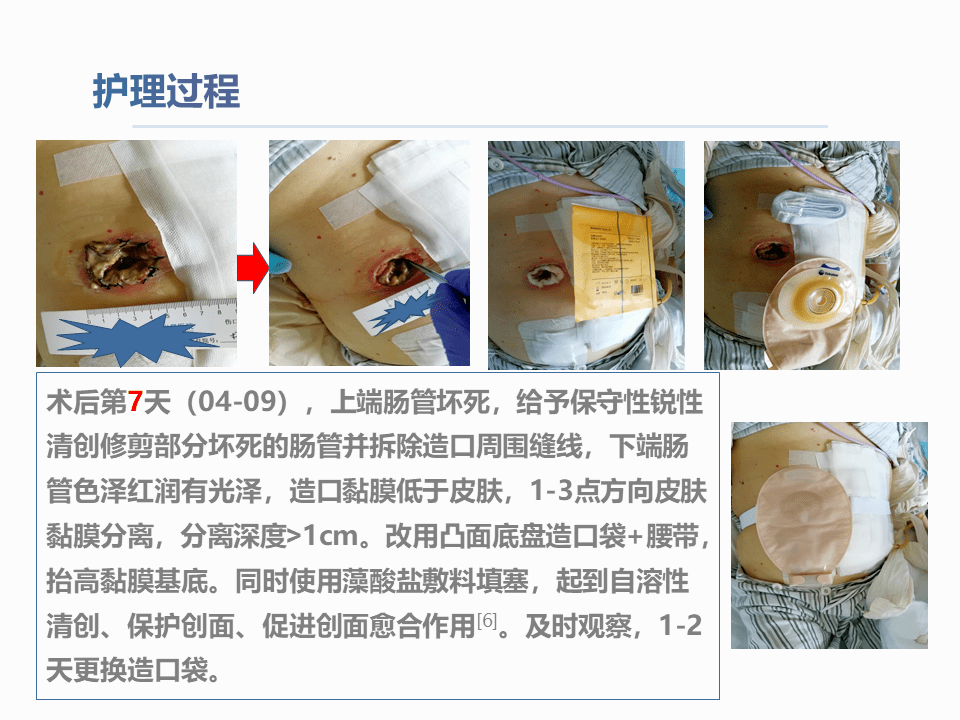 一例结肠癌术后肠造口缺血坏死护理查房