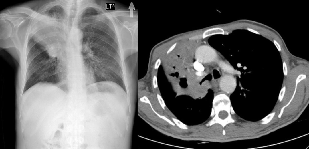 右肺支气管恶性肿瘤:右肺门肿块阻塞右上叶支气管,导致右上叶不张.