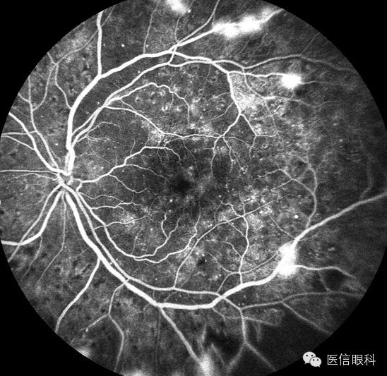 关注眼健康带你了解糖尿病性视网膜病变