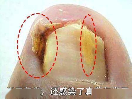 用它一贴,1分钟止痛,趾甲往