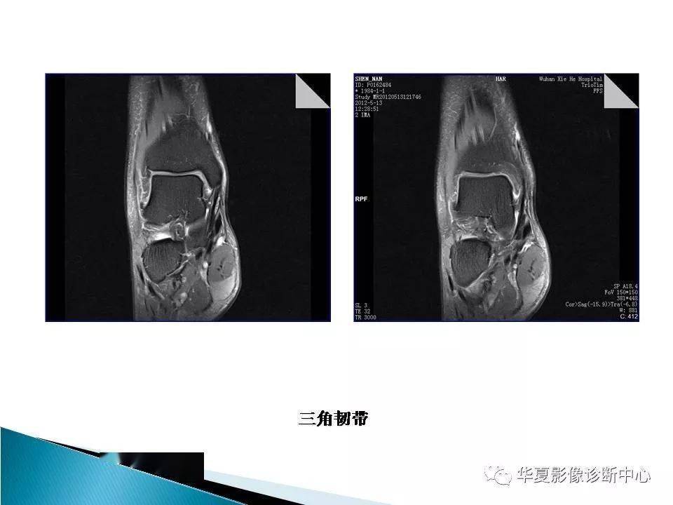 踝关节的解剖及mri扫描技术