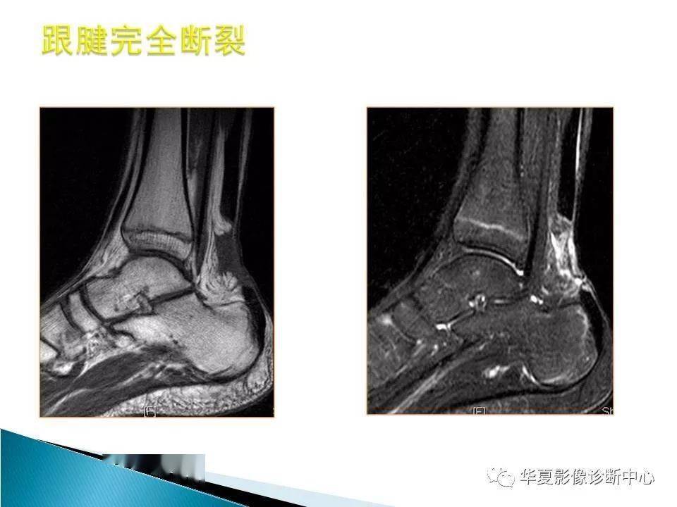 踝关节的解剖及mri扫描技术