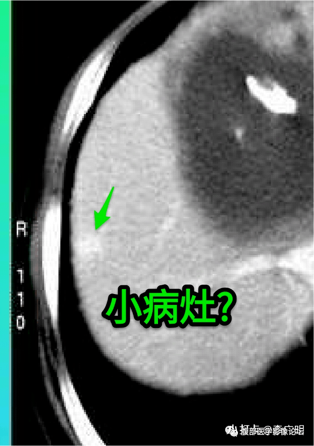 肝脏丨肝脏孤立性纤维瘤