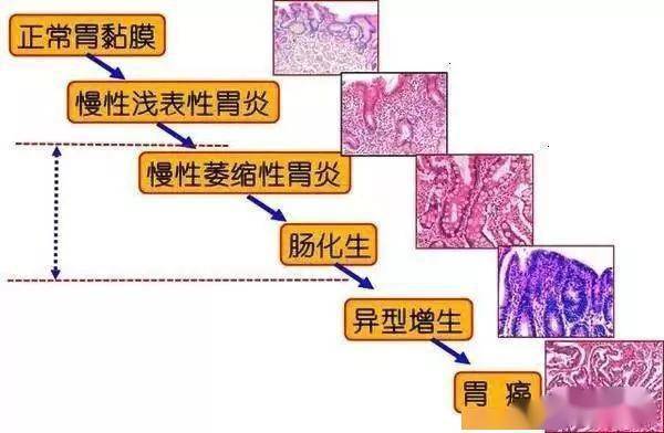 图4 胃癌发展示意 黏膜的肠上皮化生作为胃癌发生多步骤假设的中间