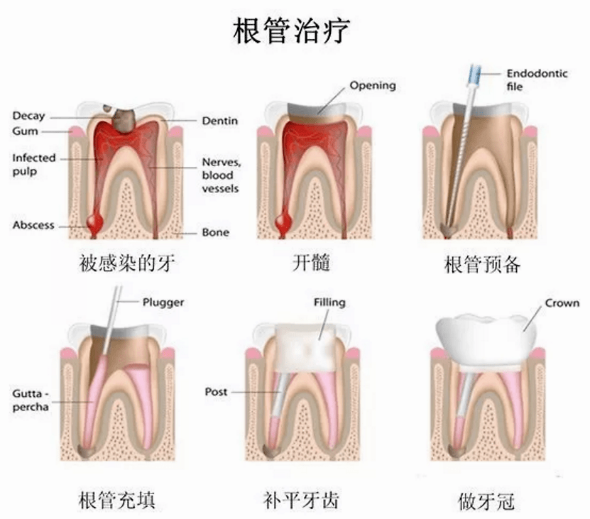 如果根管治疗后坚决不戴牙冠,会怎么样?_牙齿