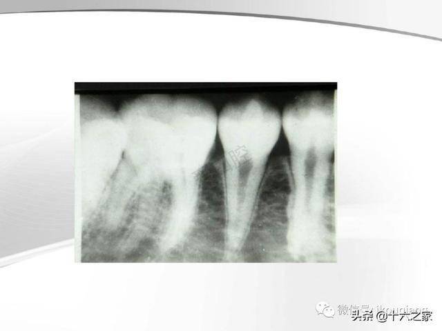牙及牙周各种疾病影像学表现整理
