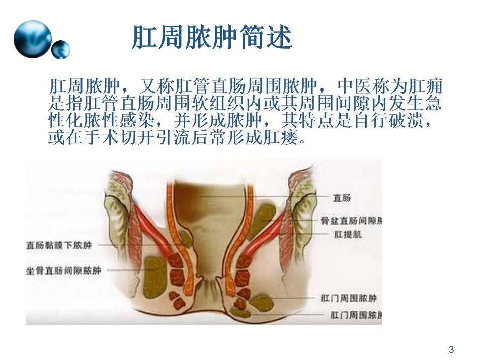 【ppt】一例肛周脓肿术后切口护理