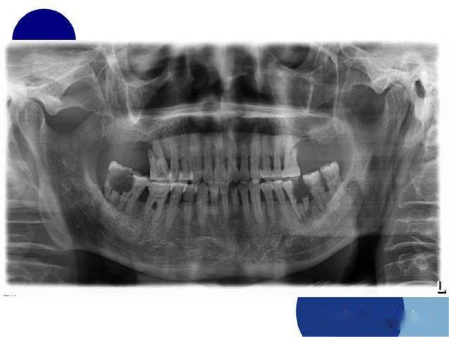 牙及牙周各种疾病影像学表现整理