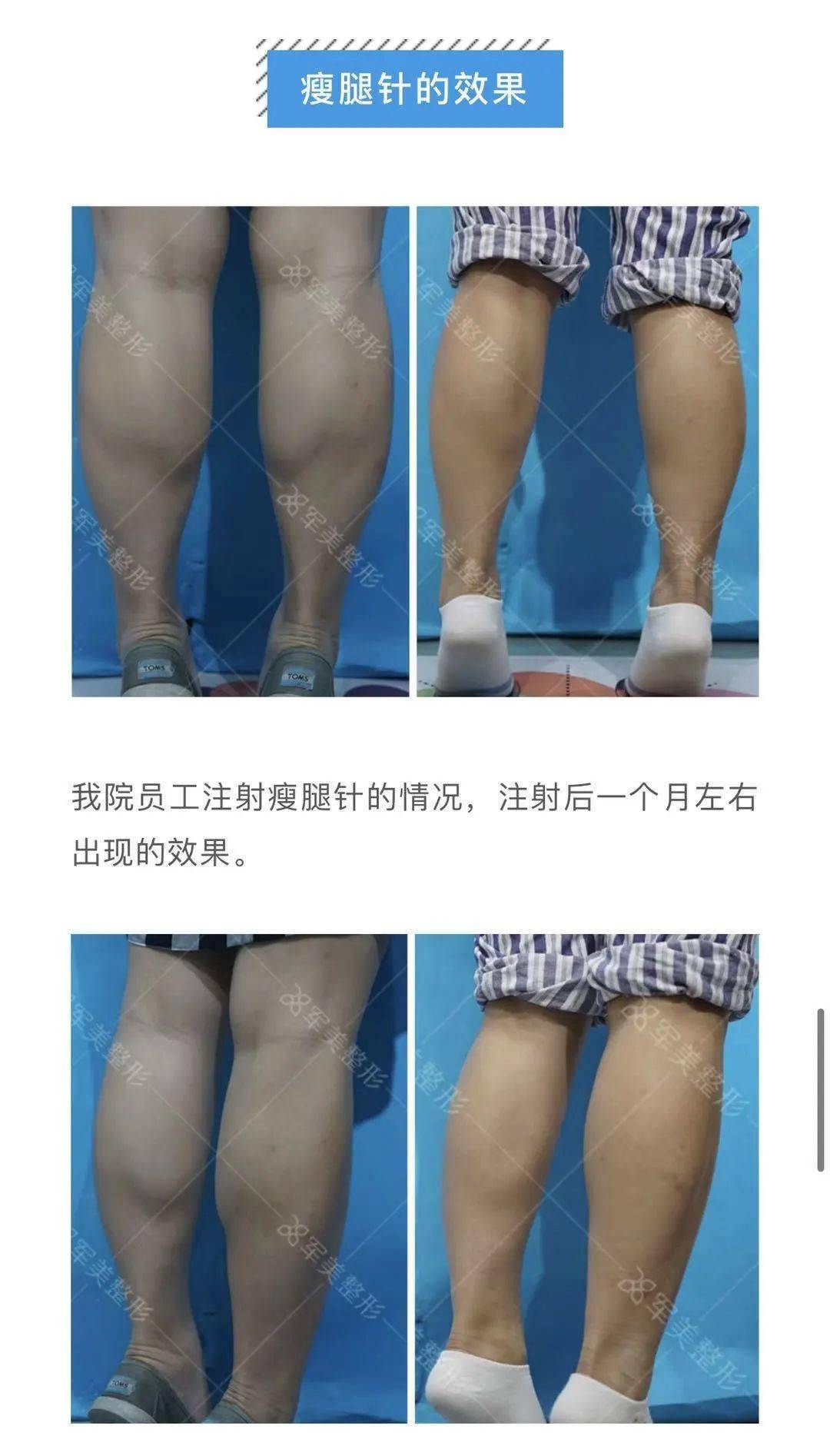 爱美却遭了罪!一女子打完瘦腿针,变成"长短腿"
