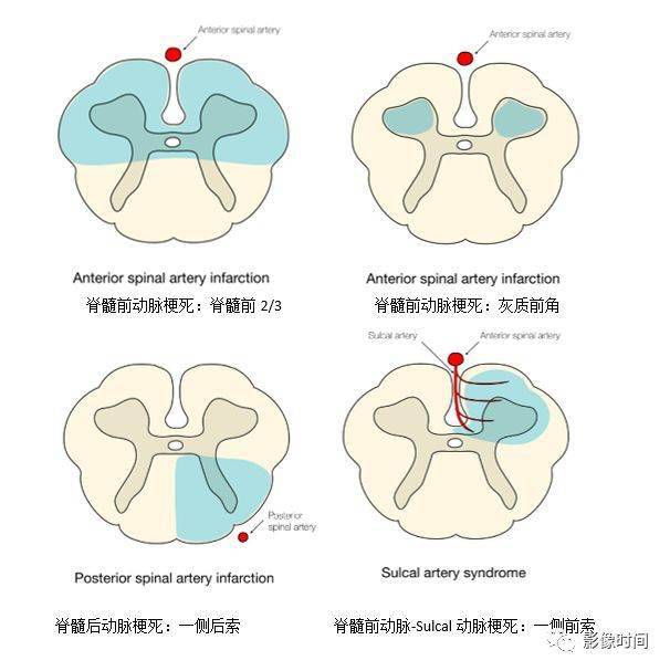 17种脊髓病变影像解读你get了吗