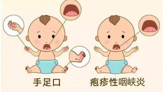 从临床表现看,疱疹性咽峡炎主要表现为高热,咽痛,口痛,拒食,流口水