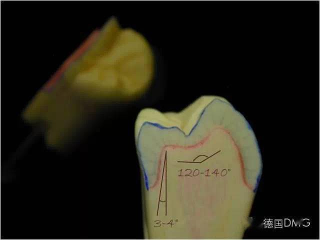 制备全瓷牙牙体容易被忽视的问题 | 口腔家园