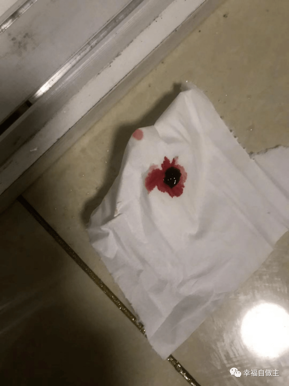 膀胱癌案例