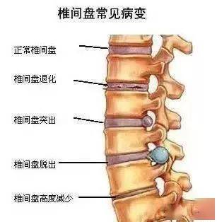 危害一:腰椎退变,并发腰腿疼痛
