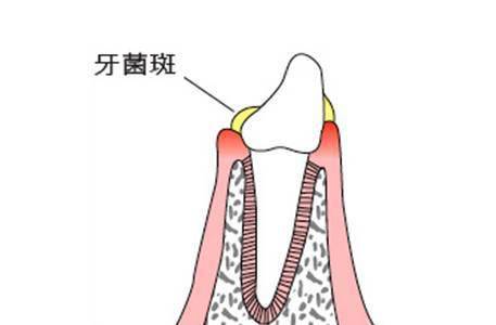 烂牙齿怎么办