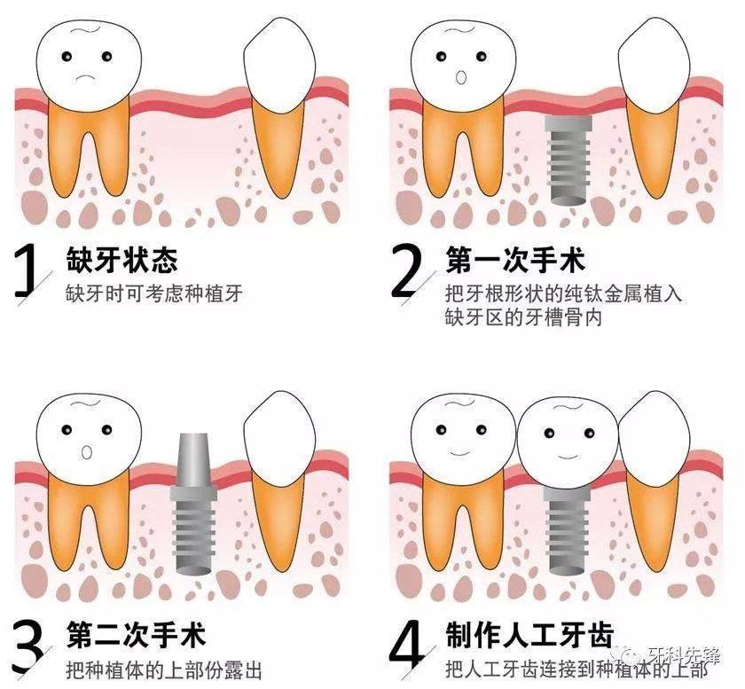 根据医生的设计方案,通过手术将种植体植入牙槽骨内.