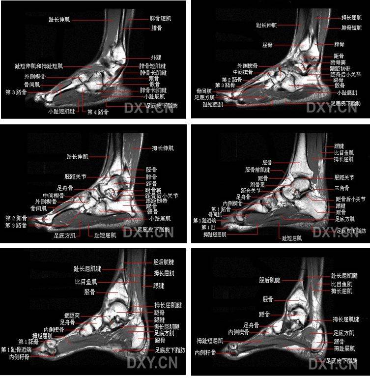 踝关节mri解剖及7种常见损伤类型
