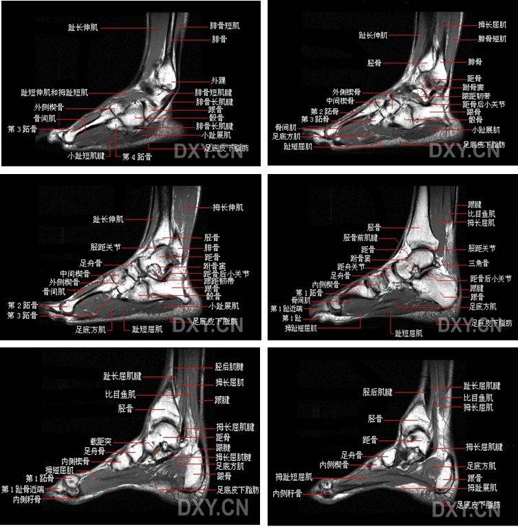 踝关节mri解剖及7种常见损伤类型!