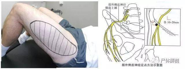 难的是,您得能摸得出股外侧皮神经,然后轻柔地将它推离现在卡压的位置