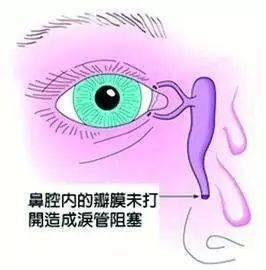 宝宝|宝宝老是有眼屎？有可能是泪管阻塞