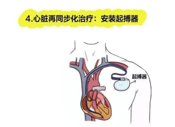 心脏移植