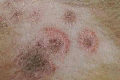 人皮肤真菌感染图片