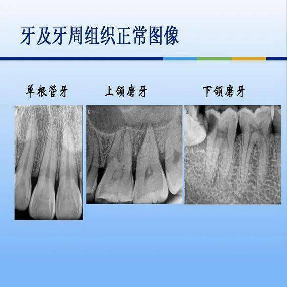 牙体牙周正常解剖及常见病x线表现