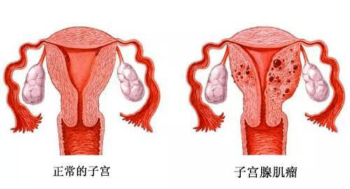 【妇儿医讯】得了子宫腺肌病怎么办?hifu或许是个不错