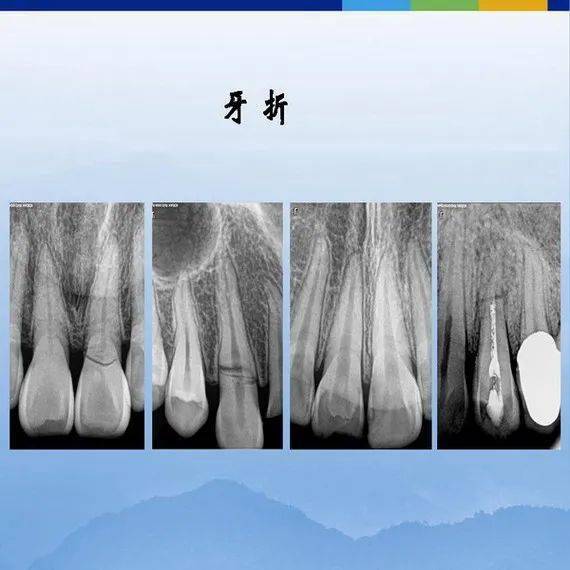 牙体牙周正常解剖及常见病x线表现