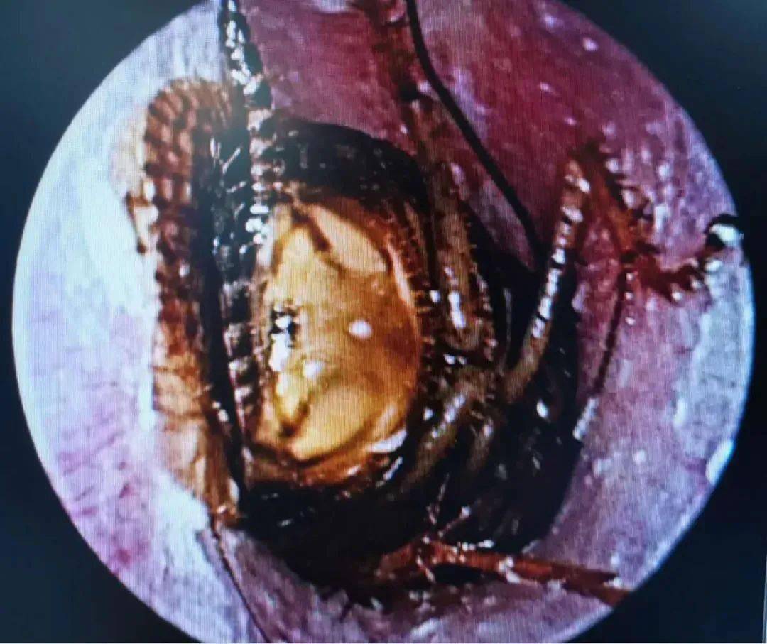 蟑螂卡在耳朵里!市中心医院接诊了一位特殊的外耳道异物患者