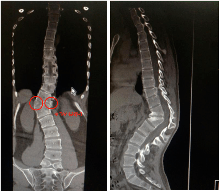 钟志宏指出,先天性脊柱后凸畸形的发病率比先天性脊柱侧凸要低,但如