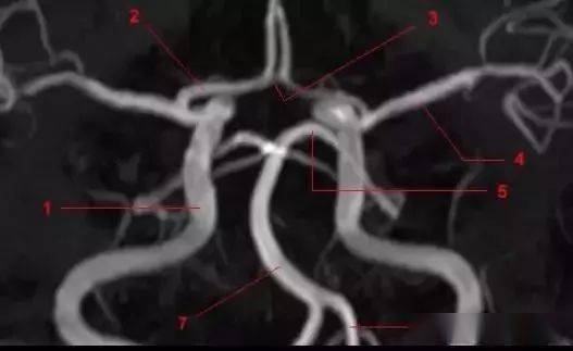 2,大脑前动脉.3,前交通动脉.4,大脑中动脉.5,大脑后动脉.6,椎动脉.