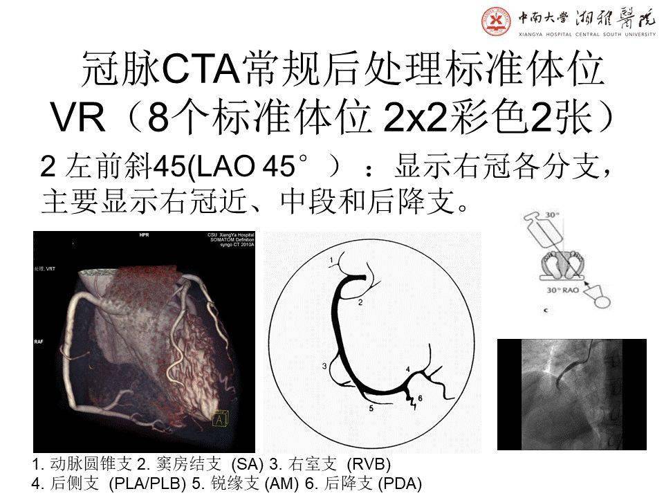 湘雅冠脉cta标准化后处理及规范化报告