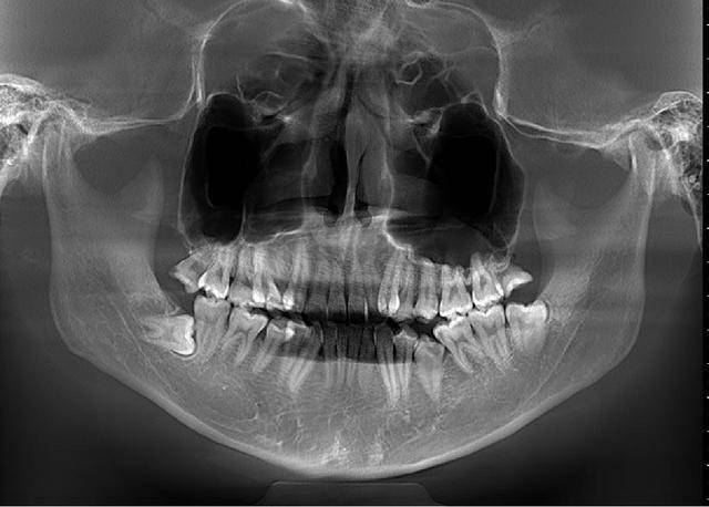 给一个患者拍的牙片,每颗牙齿的形态和位置清晰可见