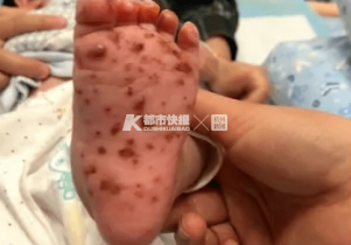 什么是单纯疱疹病毒 989eb197ea6249be96e1ae259d6f597e.png