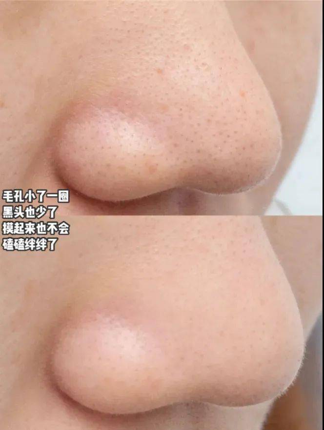 闭口@,脸上“小疙瘩”老去不掉?幸亏我没放弃这么做,原来额头可以这么光滑