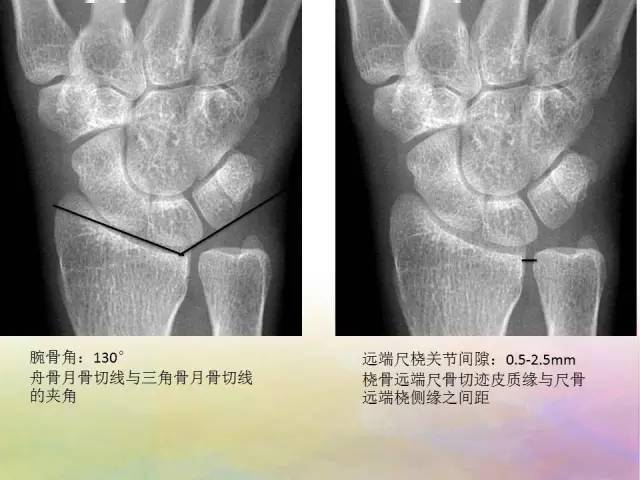 基础学习腕关节解剖详解