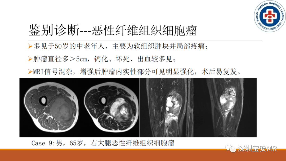 结节性筋膜炎临床与影像