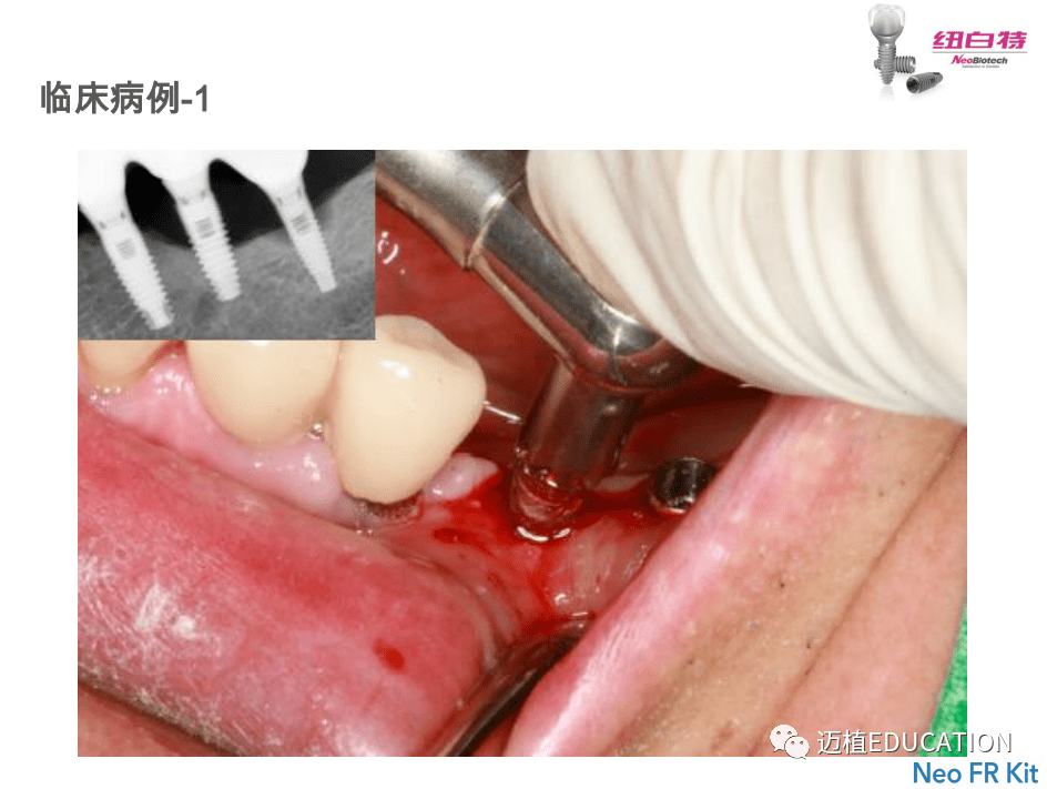 neo纽白特取出种植体工具盒