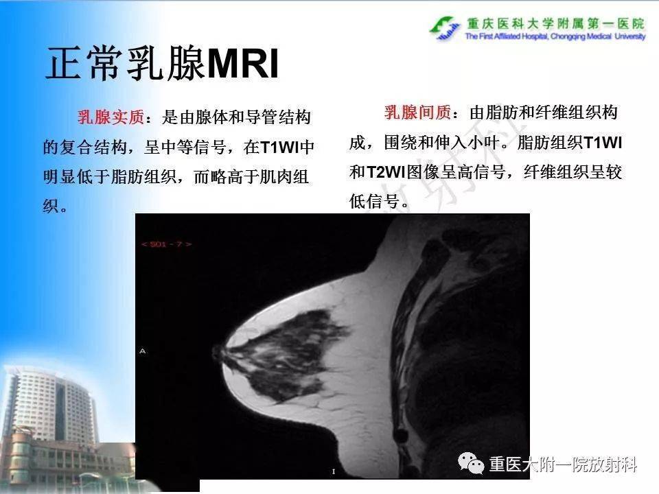 mri在乳腺癌中的应用