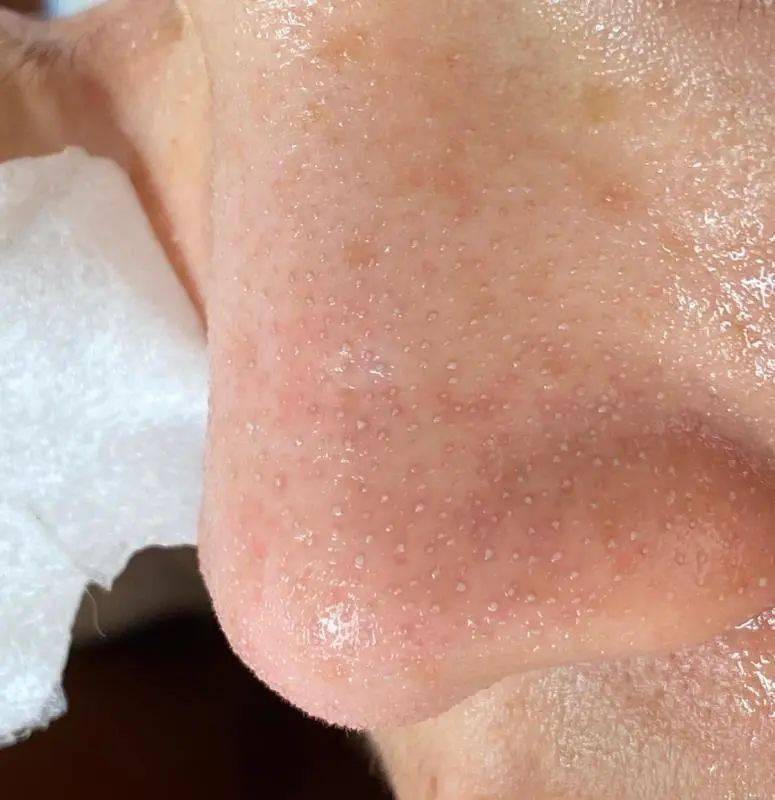毛孔|原来想要拥有干净、清透的“初恋素颜脸”，只需要做好这一步！