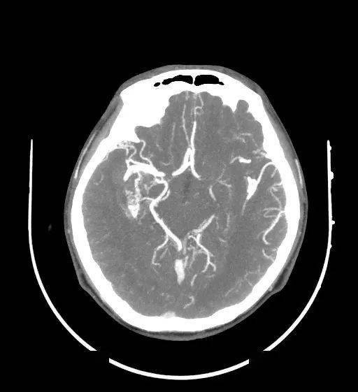 ▼颅脑cta基本证实脑血管畸形