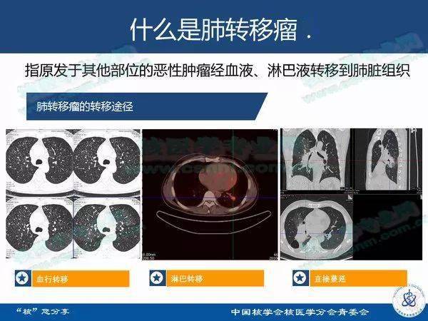 分享47期非典型肺转移瘤的影像学表现