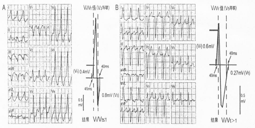室性心动过速心电图特征,6 点必掌握!