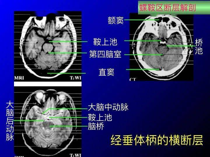 【推荐】鞍区应用解剖 断层解剖图谱