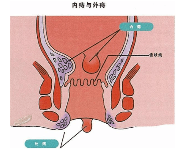 另外,肛门褶皱较多,若因肛裂或便秘等原因导致肛周出现小伤口,便后