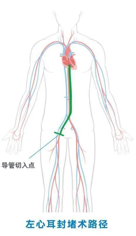 左心房人口_左心房右心房(3)