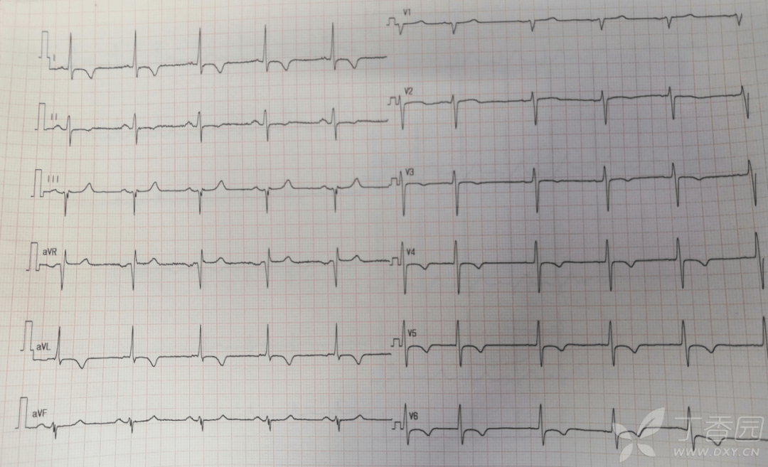 心电图:窦性心律,i,avl导联倒置及胸导联t波低平倒置