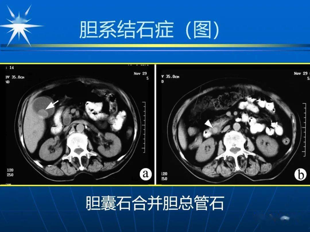 mri:t1wi和t2wi均呈低或无信号肝门区胆管癌手术后病理结果为胆总管下