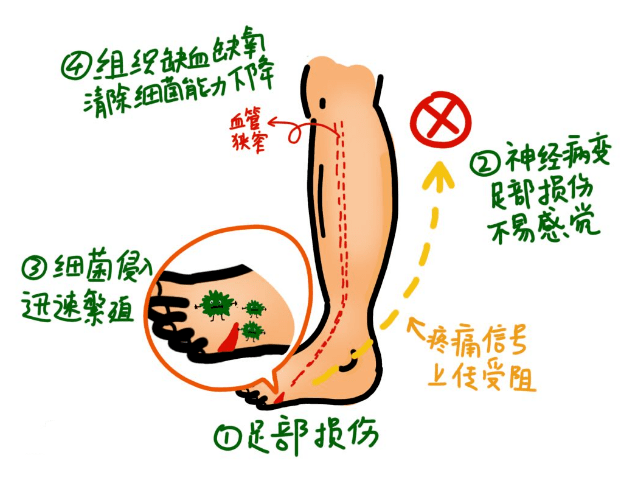 足部|脚上出现这几种异常，说明血糖已超标！